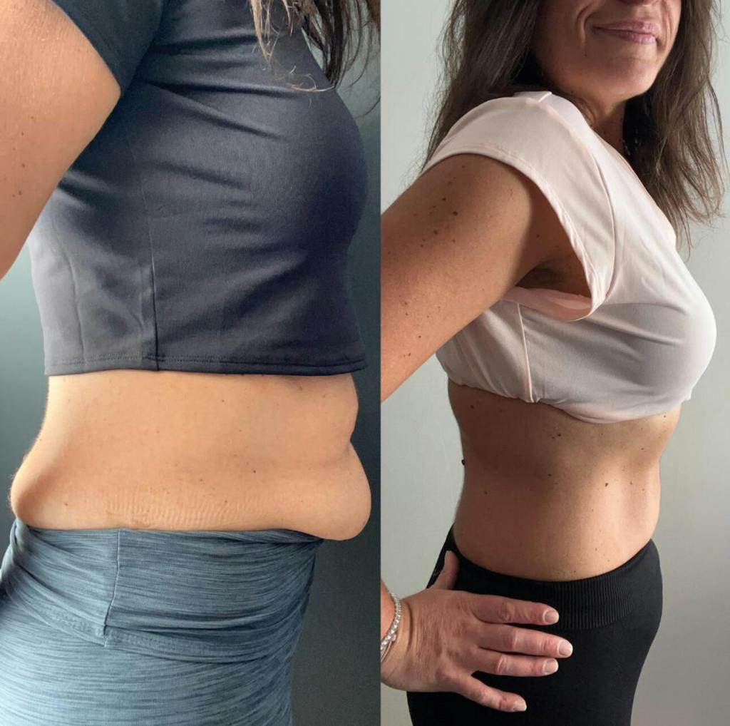 Selülitlerim Silindi!